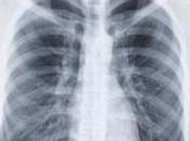 différentes classes sociales, inégales face cancer poumon