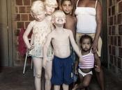 Trois albinos dans m&#234;me famille