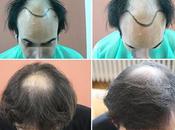 4297 Clinic Bisanga Clinique greffe cheveux photos avant après