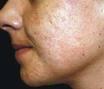 recommandations pour prévenir l'acné