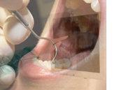 Parodontiste parodontologue dentiste spécialiste gencives