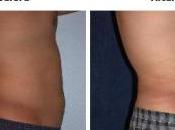 CHIRURGIE ESTHÉTIQUE hommes plus candidats bistouri American Society Plastic Surgeons (ASPS)