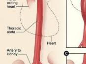 ANEVRYSME l’AORTE: bactéries bouche l’aorte Inserm-PloS