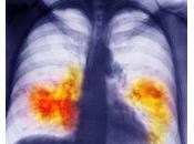 CANCER POUMON avancé: Meilleure efficacité démontrée d’une double chimio Lancet