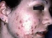 Méthodes naturelles pour lutter contre l'acné adulte