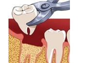 Dent arrachée soins après extraction dentaire