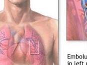 Maladies AUTO-IMMUNES: Multiplication risque d’embolie pulmonaire Lancet