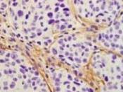 CANCER: Découverte protéine reprogramme cellules tumorales Nature Medicine