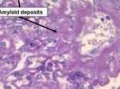 ALZHEIMER: Vers test détection biomarqueur sanguin Archives Neurology