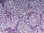 CANCER PANCRÉAS: Amgen stoppe essais Ganitumab Phase