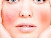 Comment traiter varicosités visage