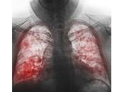 Pneumonie aigüe système cardiovasculaire