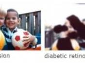 DIABÈTE rétinopathie: traitement combiné protège vaisseaux l'oeil American Society Cell Biology