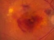 DMLA: collyre anti-cholestérol pour ralentir Cell Metabolism