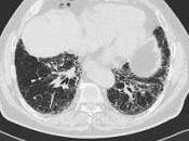 Variantes génétiques associées susceptibilité fibrose pulmonaire idiopathique mortalité: étude d’association pangénomique