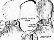 greffe tête bientôt possible selon neurologue