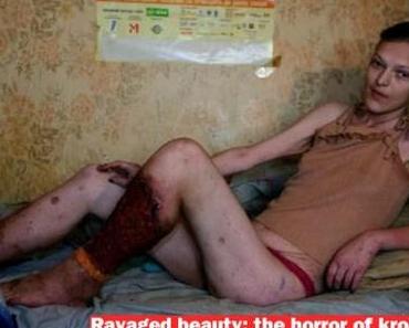 ALERTE INFO ! Photos: de nouvelles images des victimes de la "drogue Krokodil"