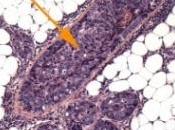 CANCER SEIN: injection nanoparticules bloque gènes responsables Science Translation Medicine
