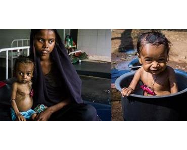 8 millions d’Indiens de moins de 5 ans souffrent de malnutrition aiguë sévère