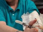 Amputation Première prothèse main avec sens toucher intégré
