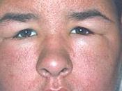 Proactiv, Neutrogena, Aveeno Importante mise garde produits contre l'acné