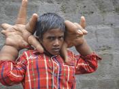 Mohammad Kaleem, garçon mains difformes