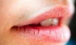 Recettes naturelles pour soigner lèvres gercés douloureuses