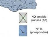 DÉMENCE: détecter avant premiers symptômes Lancet Neurology