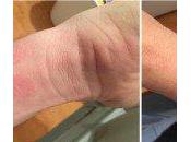 Apple Watch allergies poignets certains utilisateurs