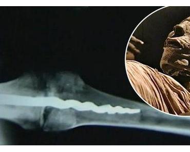 Le mystère d’une broche orthopédique au genou d’une momie égyptienne de 3000 ans