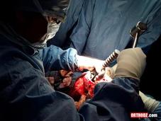 Nouvelle technique chirurgie prothétique genou Algérie