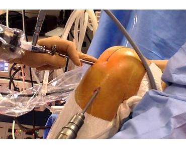 6 causes d’échec de la chirurgie du ligament croisé antérieur (LCA)