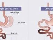 CHIRURGIE BARIATRIQUE: Elle s'attaque avant tout glucose Gastroenterology