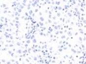 MÉLANOME: Découverte d'un gène suppresseur tumeur Nature Genetics