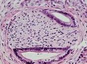 #thelancet #cancerdupancreas #irinotecan #fluorouracile #acidefolinique #gemcitabine Irinotecan nanoliposome avec fluorouracile acide folinique dans cancer pancréas métastatique après précédent traitement base gemcitabine (NAPOLI-1)