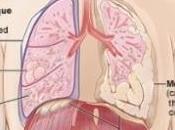 MÉSOTHÉLIOME: nouveau traitement redonne espoir Cancer