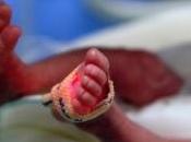 EXTRÊME PRÉMATURITÉ: corticothérapie préventive bénéfique dans survie sans maladie pulmonaire chronique Lancet AP-HP
