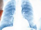 CANCER POUMON: Dépistage systématique ciblé pour améliorer survie