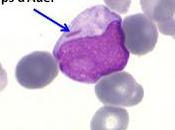 #thelancethaematology #LAM #leucémieaigueëmyéloïde #cellulesprogénitrices #HLA Perfusion cellules progénitrices HLA-incompatibles multiplication ex-vivo issues sang ombilical après chimiothérapie intensive contre leucémie aiguë myéloïde