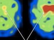 PARKINSON: NAC, protéine booste dopamine PLoS