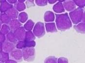 LEUCÉMIE MYÉLOÏDE CHRONIQUE: traitement cellules souches leucémiques Cancer Discovery