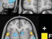 FIBROMYALGIE: trouvé signature neurophysiologique Pain