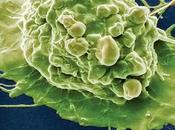 CANCER VESSIE L'acide aminé rend accros carcinomes American Journal Pathology