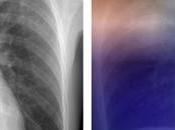 TUBERCULOSE L'intelligence artificielle pour diagnostiquer Radiology