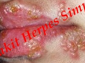 obat herpes bawang putih