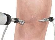 Intérêt lavage articulaire dans l’arthrose genou
