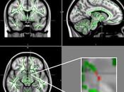 OBÉSITÉ l’ADOLESCENCE perturbation l’appétit dans cerveau