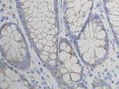 #thelancetgastroenterologyandhepatology #cancercolorectal Inhibition signalisation EGFR, HER2, HER3 chez patients atteints d’un cancer colorectal gènes BRAF, PIK3CA, KRAS, NRAS type sauvage (FOCUS4-D) essai randomisé phase