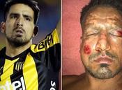 Quand joueur foot argentin blesse visage lors d’un d’artifice