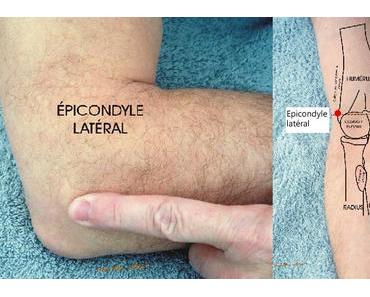 Épicondylite latérale : traitement médical et chirurgical